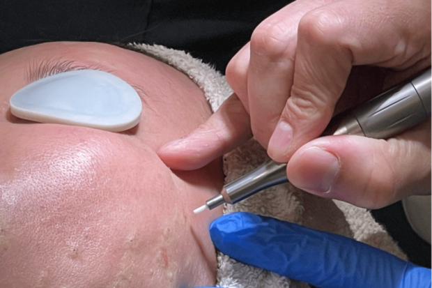 CO2レーザーで稗粒腫を除去！麻酔をしていたので痛みはナシ！