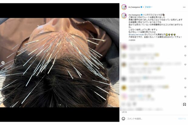長谷川理恵は以前にもルート治療を受けていた(本人インスタグラムより)