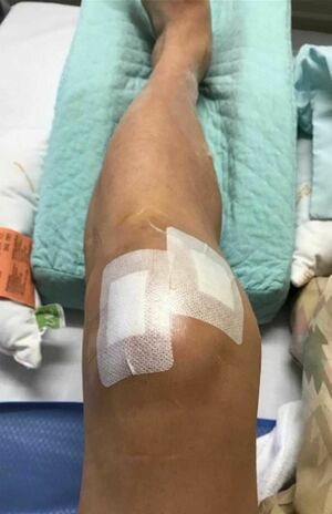 手術から400日後、ベーカー嚢胞発症から5か月後、病院のリハビリを終えて記念撮影（佐藤弘道さんのブログより）