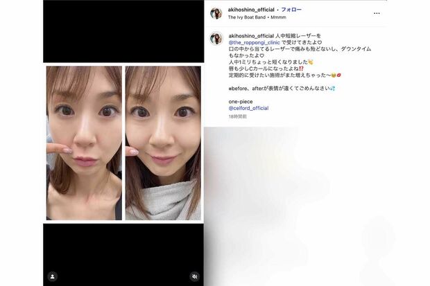 「人中短縮レーザー」を受けたことを報告したほしのあき(本人のインスタグラムより)