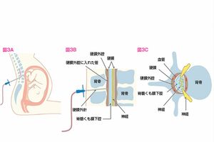左から母体図3A。背中拡大図3B。背骨断面図3C。手順は硬膜外腔に入れた針の中から細い管を入れる（図3B）。管を残し針を抜く。管からの薬が硬膜外腔周囲の神経（図3C）に効き痛みを抑える（出典：日本産科麻酔学会）