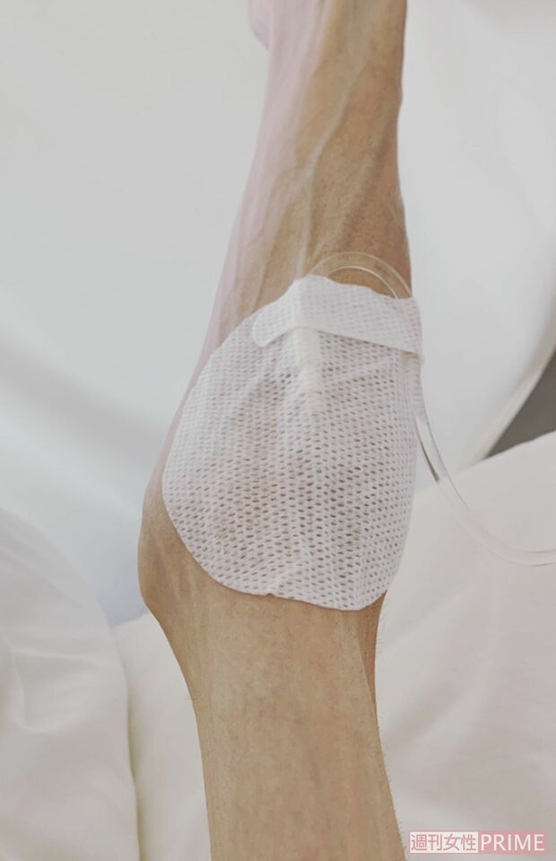 貧血や低カリウム血症などの不調があり、点滴や鉄剤輸液で補ったりしている