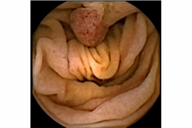 実際にポリープを発見したときの画像　画像提供／コヴィディエンジャパン株式会社