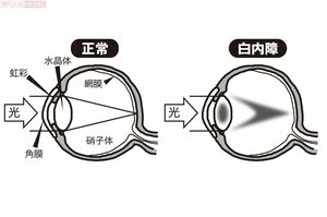 透明な水晶体は光を十分に通す。白内障は水晶体が濁り、光が通りにくくなる イラスト/つのだだいすけ