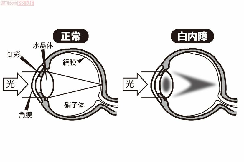 画像 写真 40 50代は高齢者より進行が早い 白内障 医師に聞く正しい予防法と 最新事情 ニュース概要 週刊女性prime