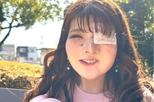 あやかさん/1991年、岐阜県生まれ。生まれつき顔の左側の骨が成長しない「左顔面骨形成不全症」。現在はアパレル業界で働きながら、Instagramやブログで自らについて発信。おしゃれ眼帯の制作も行っている。