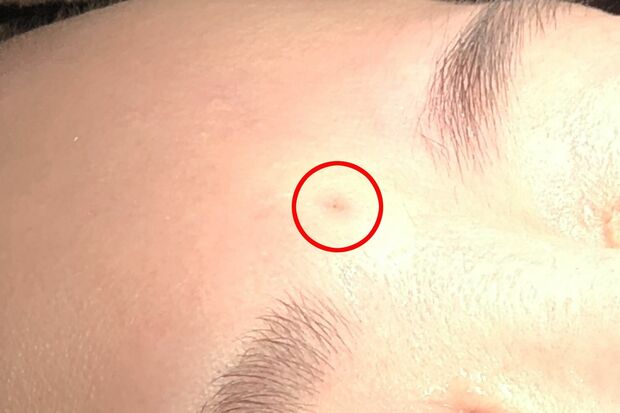 施術直後、眉間のホクロはピンク色に
