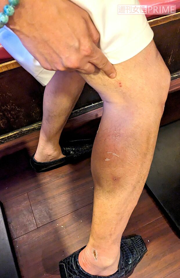 ベトナムで負ったケガを見せるいしだ壱成。ここが化膿して破傷風と思い込んだと語る