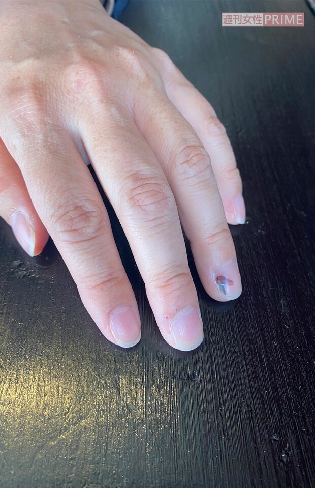 被害は1か月前だが血豆の痕が生々しい