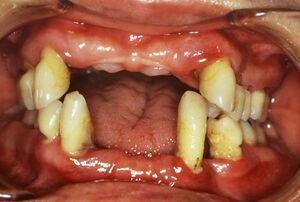 進行が早い歯周病は、あっという間に歯を失う。40代で入れ歯になることも