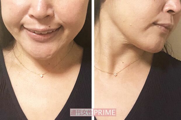 写真左：笑うと気になっていた両頬下の肉が減ってスッキリ！　写真右：横から見てもシャープに