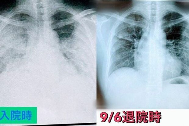 左・9月2日、愛知のセカンドオピニオン病院の入院時、右・9月6日、同病院の退院時　（写真：取材者提供／東洋経済オンライン）