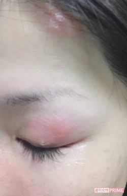 左おでこ、左目に症状が出た女性。治療が間に合わず痕が残った