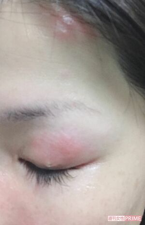 左おでこ、左目に症状が出た女性。治療が間に合わず痕が残った