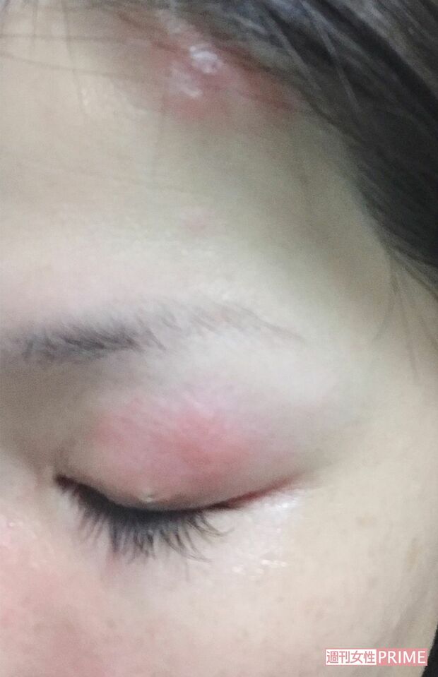 左おでこ、左目に症状が出た女性。治療が間に合わず痕が残った