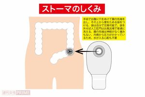 ストーマのしくみ