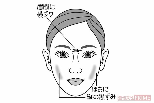 ほおの黒ずみ　イラスト／石崎伸子