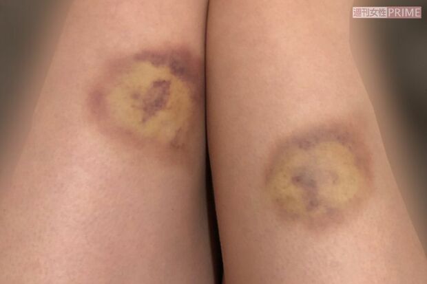 山本亮太による性行為中の暴力行為により、Aさんの身体には、いたるところに痛々しいあざがつけられていた