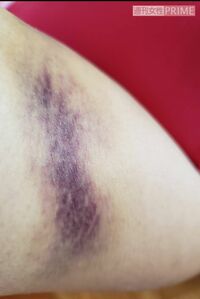 美奈子さんがAに殴られたアザ。これを見せてもなお警察は動こうとしなかった