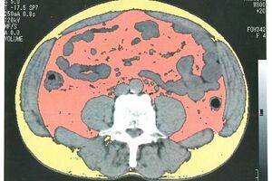 内臓の周辺に内臓脂肪（ピンク）がたっぷりとついているのがわかる。その周りを皮下脂肪（黄色）が取り囲んでいる（提供／栗原毅先生）