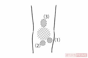 「ひざのコブ」（イラスト／日江井香）