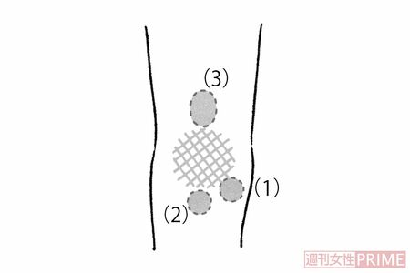 「ひざのコブ」（イラスト／日江井香）