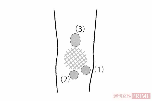 「ひざのコブ」（イラスト／日江井香）