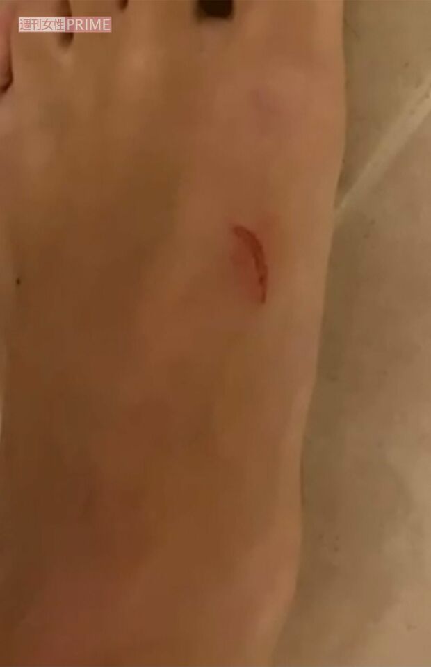 Ａ子からの暴力でできた、小澤の身体の傷4