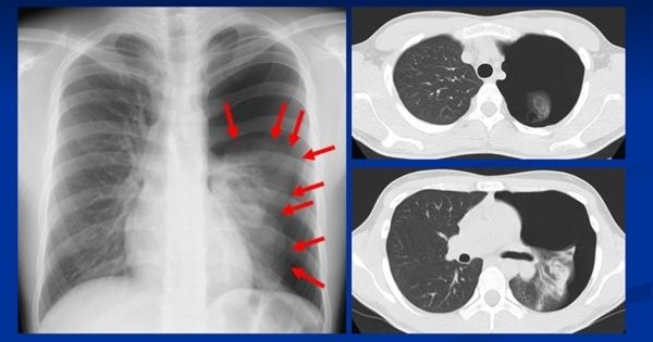 18歳男性＝原発性自然気胸のX線写真。もやのような細い網目模様は肺の中に走る血管。向かって左の肺に比べると、右の肺の上半分に網目模様（血管）がないことが見て取れる。肺が矢印の位置まで押しつぶされてしまっている。右側の2枚のCT画像は、輪切りにした体内を写し出したもの。肺上部（上）と比べても、下部（下）は特にひしゃげているのがわかる