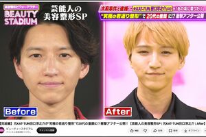 YouTube番組『ビューティースタジアム』で若返り整形に挑戦した田口淳之介。ビフォーと比べると若々しい印象に