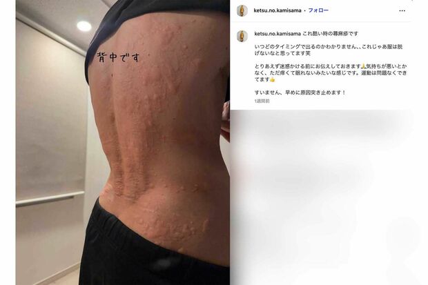 背中全体に蕁麻疹がびっしり広がっているゴールデンボンバーの樽美酒研二（本人のインスタグラムより）