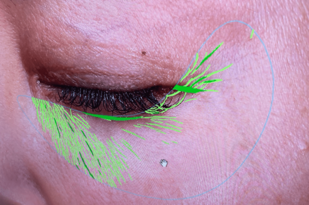 VISIAによる目の周りのシワ解析