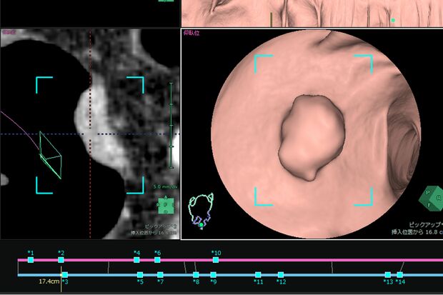 3D画像から病変と疑われる領域を発見した場面　画像提供／富士フイルムヘルスケア株式会社