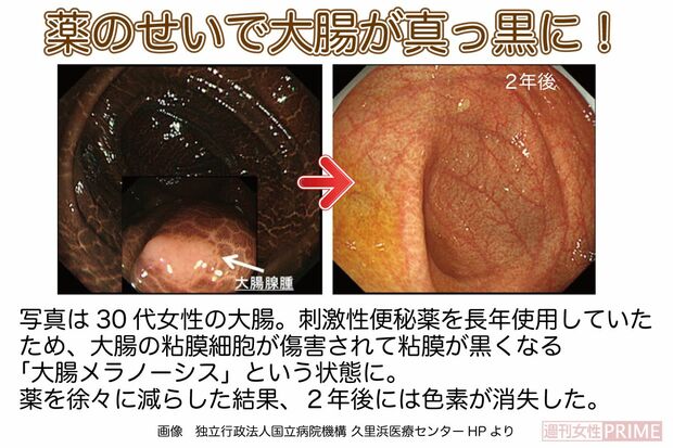 便秘薬の使い過ぎで大腸が真っ黒に