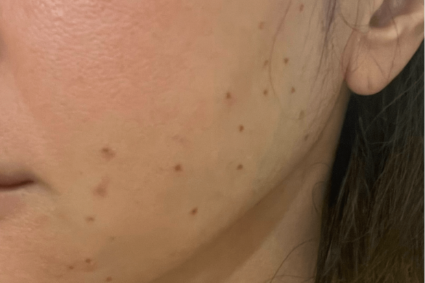 稗粒腫施術直後