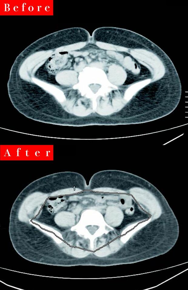 内臓脂肪を減らしてマイナス6kg！