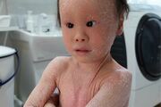 《ピエロと呼ばれた息子》30万人に1人の『道化師様魚鱗癬』を患う子どもと家族の8年間「いっそ…」出産直後に壮絶な葛藤