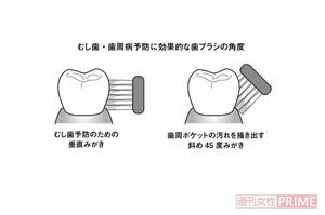 むし歯・歯周病予防に効果的な歯ブラシの角度