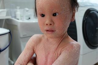 《ピエロと呼ばれた息子》30万人に1人の『道化師様魚鱗癬』を患う子どもと家族の8…