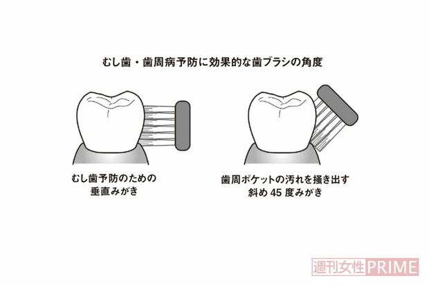 むし歯・歯周病予防に効果的な歯ブラシの角度