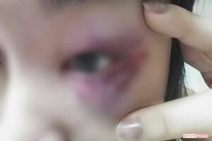 転んでぶつけたと片瀬美月さんが言っていたアザの写真だが、殴られたようにも見える