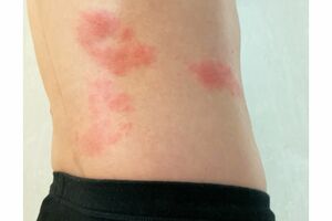 帯状疱疹ワクチンを接種したほうがいいのでしょうか、専門家が解説します