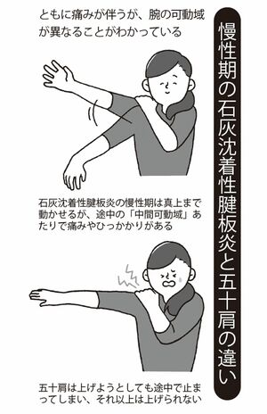 治療法は石灰に直接ステロイド剤を注入する方法などがある。患者数も多い病状のため、ほかにもさまざまな治療法が導入されだしている