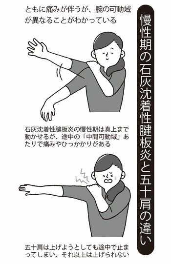 治療法は石灰に直接ステロイド剤を注入する方法などがある。患者数も多い病状のため、ほかにもさまざまな治療法が導入されだしている