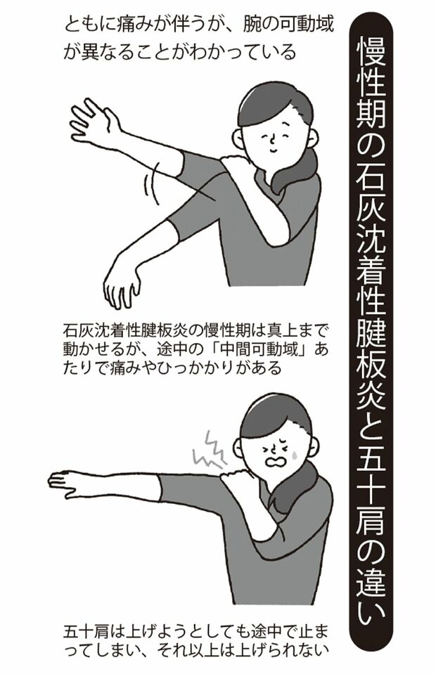 治療法は石灰に直接ステロイド剤を注入する方法などがある。患者数も多い病状のため、ほかにもさまざまな治療法が導入されだしている