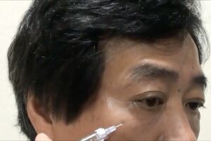 征矢野先生は自身で製剤を体験し、その結果をYouTubeやブログで配信している。コラーゲン注入のイメージをつかんでもらうために、院長自ら自身の目の下のしわへコラーゲン注入