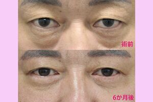 前田医師が“下眼瞼切開術（ハムラ法）”を用いて執刀した患者のビフォーアフター（提供／TAクリニック）