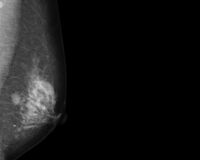 乳がん、再発の可能性がない全摘で再建手術をするのが主流