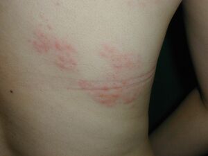 腹部、背部などに出た帯状疱疹の中等症状。主に上半身、片側の目の上から額にかけて、お腹の側面に出 ることが多く、発疹が広範囲に及ぶ場合も。このほか、首、腕、臀部や脚に出ることもある