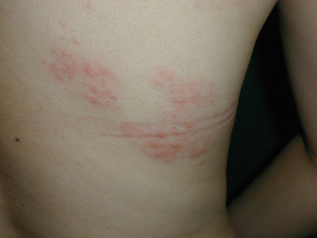 腹部、背部などに出た帯状疱疹の中等症状。主に上半身、片側の目の上から額にかけて、お腹の側面に出 ることが多く、発疹が広範囲に及ぶ場合も。このほか、首、腕、臀部や脚に出ることもある